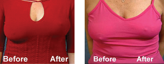 Perk Up Your Breasts with a Breast Lift